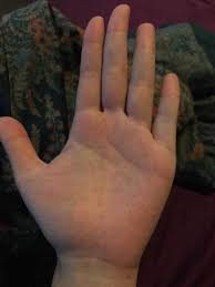 Payudara akan terasa sakit atau nyeri saat dipegang. Hey Remaja Pun Masih Boleh Dijangkiti Hfmd Seperti Gadis Ini Remaja