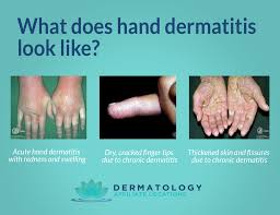 Image result for Hand Dermatitis