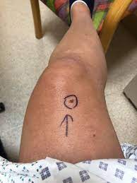 The earlier a skin cancer is diagnosed, the easier it is to treat. Tiny Mark On Dancer S Knee Spotted By Holiday Maker Turns Out To Be Deadly Condition Mirror Online