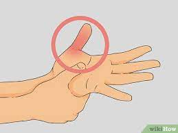Einen Gebrochenen Daumen Diagnostizieren Wikihow