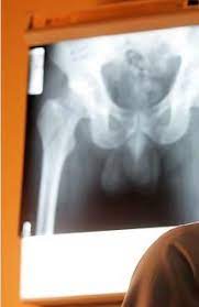 Maybe you would like to learn more about one of these? X Ray Dcm X Ray Images Hip X Ray