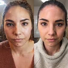 You can easily determine whether a celebrity has botox or not. My Experience Receiving Botox For Tmj Lauryncakes