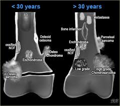 Bone Tumors Location Age Radiology Imaging Radiology Student Radiology
