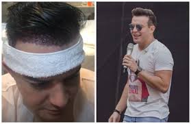 Reportaje en vídeo de un implante capilar, comentado por paciente y cirujano. Cantor Belutti Passa Por Cirurgia E Implanta 6 280 Fios De Cabelo Entretenimento R7 Musica