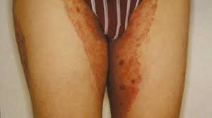 Image result for sore skin in the groin area