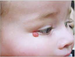 Image result for Spitz Nevus