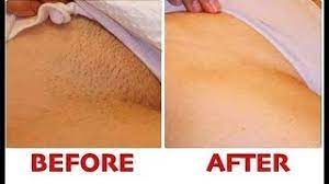 However, if you still want to keep the ingrown hair, you should trim your hair instead of removing it. Stop Shaving Proper Way To Remove Pubic Hair Without Shaving No Ingrown Hair No Boils Youtube