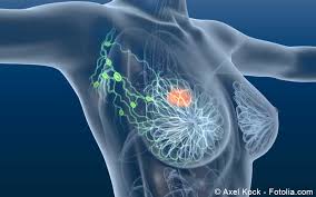 Mammakarzinom Brustkrebs Symptome Diagnostik Therapie Gelbe Liste