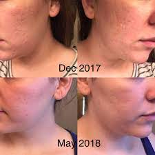 A redditor who goes by aphylaxis recently shared how she quickly dealt with a fungal acne breakout on her face on the asianbeauty subreddit. B A Continuing To Battle My Acne Scars An Update To My Routine Five Months Progress Skincareaddiction