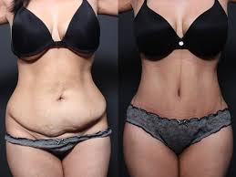 Full Tummy Tuck And Liposuction Of The Abdomen And Waist Performed At The Same Time Super Low Incisio Tummy Tucks Recovery Mini Tummy Tuck Tummy Tuck Surgery
