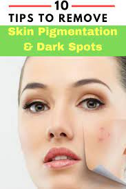 13 Home Remedies To Remove Pigmentation Naturally At Home Trabeaulli Spots On Face Pigmentation Remedy Dark Spots On Face