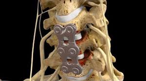 C5 6 C6 7 Anterior Cervical Discectomy With Fusion Spinal Fusion Spinal Surgery Spine Surgery