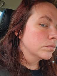 Could heat and sun reactions be related to MCAS?