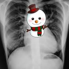 Simply push them in at the sides, either stick downward or outward (it all depends on how expressive your snowman decides to be). Snowman Sign Radiology Case Radiopaedia Org