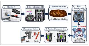 Often a biopsy test is done at the same time as the aspiration test. Cancers Free Full Text Bone Marrow Sparing Imrt In Anal Cancer Patients Undergoing Concurrent Chemo Radiation Results Of The First Phase Of A Prospective Phase Ii Trial Html