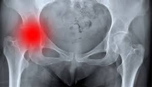 The initial signs of the disease can be difficult to detect because children have trouble describing symptoms. Hip Fracture Johns Hopkins Medicine