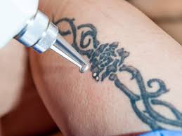 Everyone underwent something that changed him. Here S What You Can Do If You Don T Like Your Tattoo