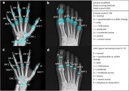 Image result for XRay Changes in Rheumatic Conditions