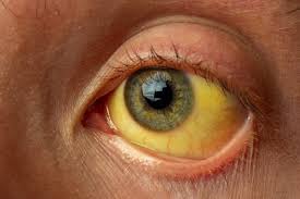 Stomach cancer begins when abnormal cells begin to grow in the cells of tissues lining or surrounding your stomach. Jaundice Pre Intra Post Hepatic Management Teachmesurgery
