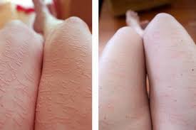 Image result for Dermatographism