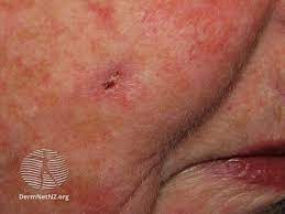 What are the blood cancer symptoms on the skin? Skin Cancer Image Gallery Pictures And Photos