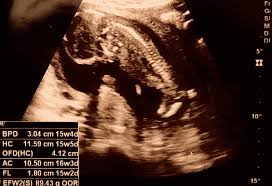 15 Weeks Pregnant Ultrasound Procedure Abnormalities And More