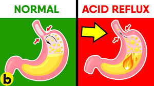 How Baking Soda Can Help With Acid Reflux Heartburn Youtube