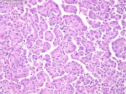 Check spelling or type a new query. Webpathology Com A Collection Of Surgical Pathology Images