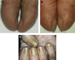 Image result for Clubbing nails feet