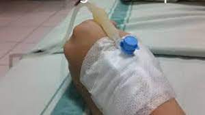Ketua ikatan dokter anak indonesia dr. Tangan Di Infus Youtube