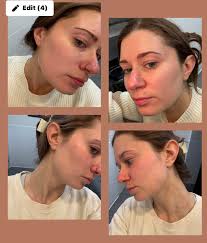 Is this a breakout or purging from new skincare?