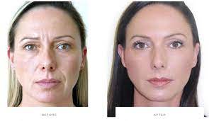 Real results from real patients. Botox Aftercare Faqs The Cosmetic Skin Clinic London Buckinghamshire