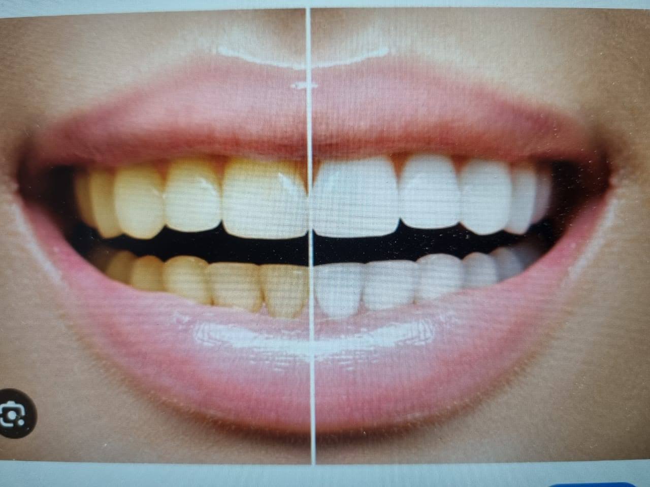TEETH WHITENING product image