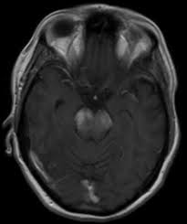 Ein kribbeln im kopf kann in seltenen fällen auf das diagnose: Zwischen Hanta Bickerstaff Und Clippers Die Diversitat Der Hirnstammenzephalitis Springerlink