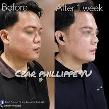 PAHELP PLS ANO PO MAS BETTER SILICON,GOROTEX OR CARTILAGE GOROTEX??