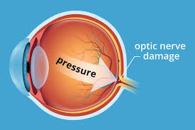 WHAT IS CONSIDERED NORMAL EYE PRESSURE? – Resuscitate Hospital