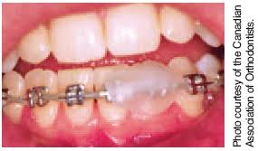 How to use orthodontic wax. Handling Appliance Complications