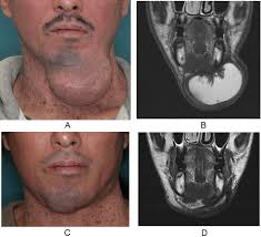 A) Initial clinical photo showing a dome-shaped subcutaneous mass in...