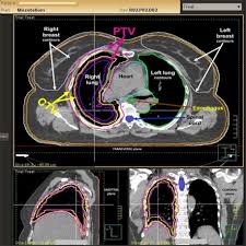 Check spelling or type a new query. Complex Target Volume Delineation And Treatment Planning In Radiotherapy For Malignant Pleural Mesothelioma Mpm