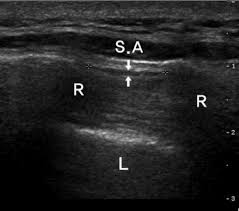 Image result for Scapulothoracic Injection