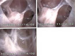 While some experts also consider sizeable residual loculations and poor lung reexpansion as possible evidence of treatment failure, other . Https Www Pgdiakonie De Fileadmin Media Kas Pdfs Kas Publikation Tuberculous Pleural Effusion Pdf