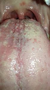 Image result for Puchýře na jazyku