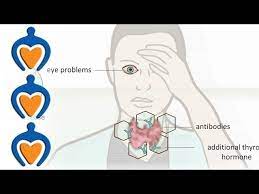 Thairath_tv line official account : Thyroid Problems Most Common Thyroid Problems Symptoms And Treatment Youtube