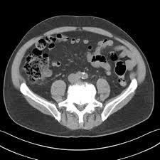 Image result for Diverticular Bleeding