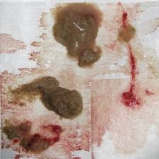 Image result for blood in stool human poop