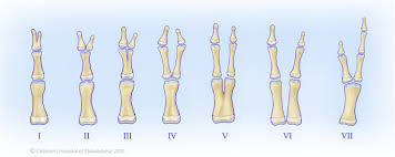 We did not find results for: Evaluation And Management Of Preaxial Polydactyly Springerlink