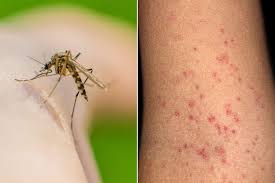 Image result for Dengue