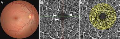 Image result for HIV Retinitis