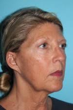 Face & Neck Lift Before and After Photos
