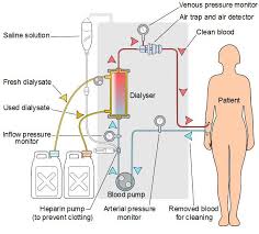 All About Kidney Dialysis You Need To Know Health Problems Are Becoming More And More Common Dialysis Dialysate Dialysis Nurse